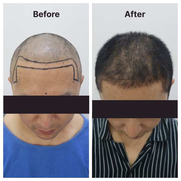 Hair Transplant result KOQ10